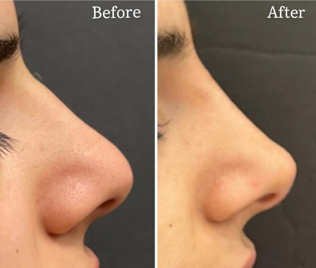 Dermal Fillers And Facial Transformation