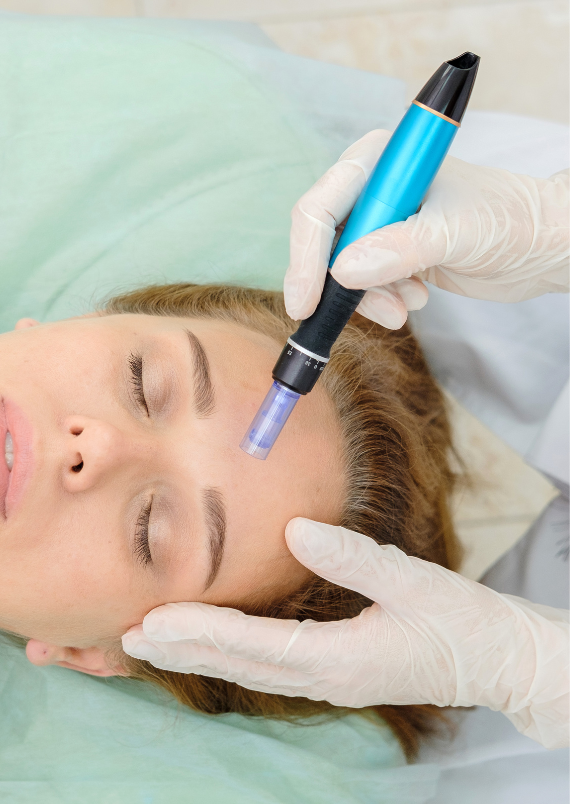 Micro-needling and Chemical Peel