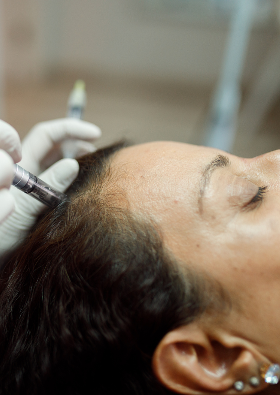 Micro-needling and Chemical Peel