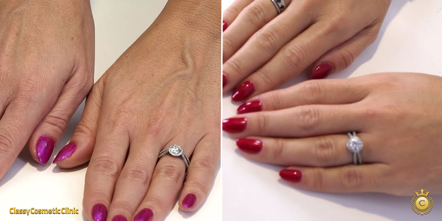 Hand Rejuvenation with Filler Injections before and after