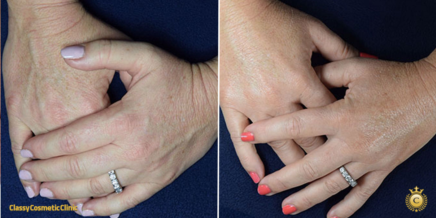 Hand Rejuvenation with Filler Injections before and after