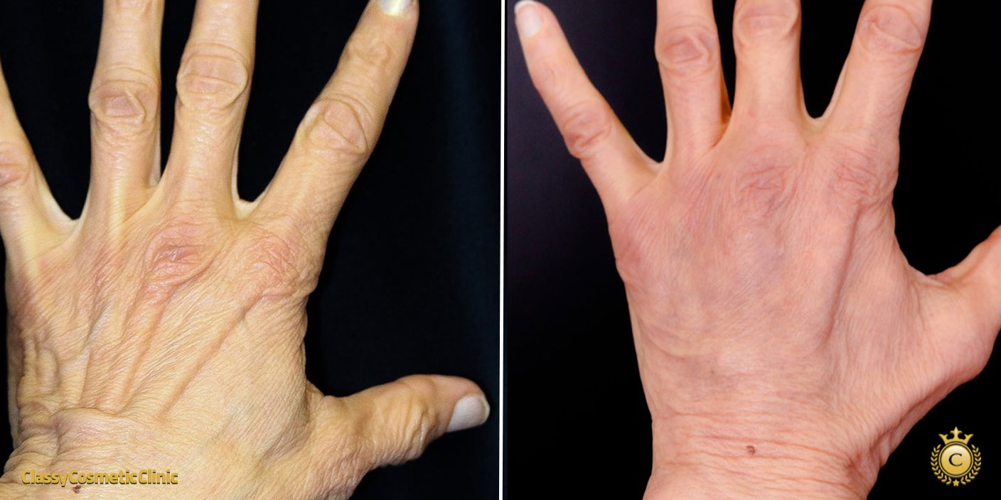 Hand Rejuvenation with Filler Injections before and after