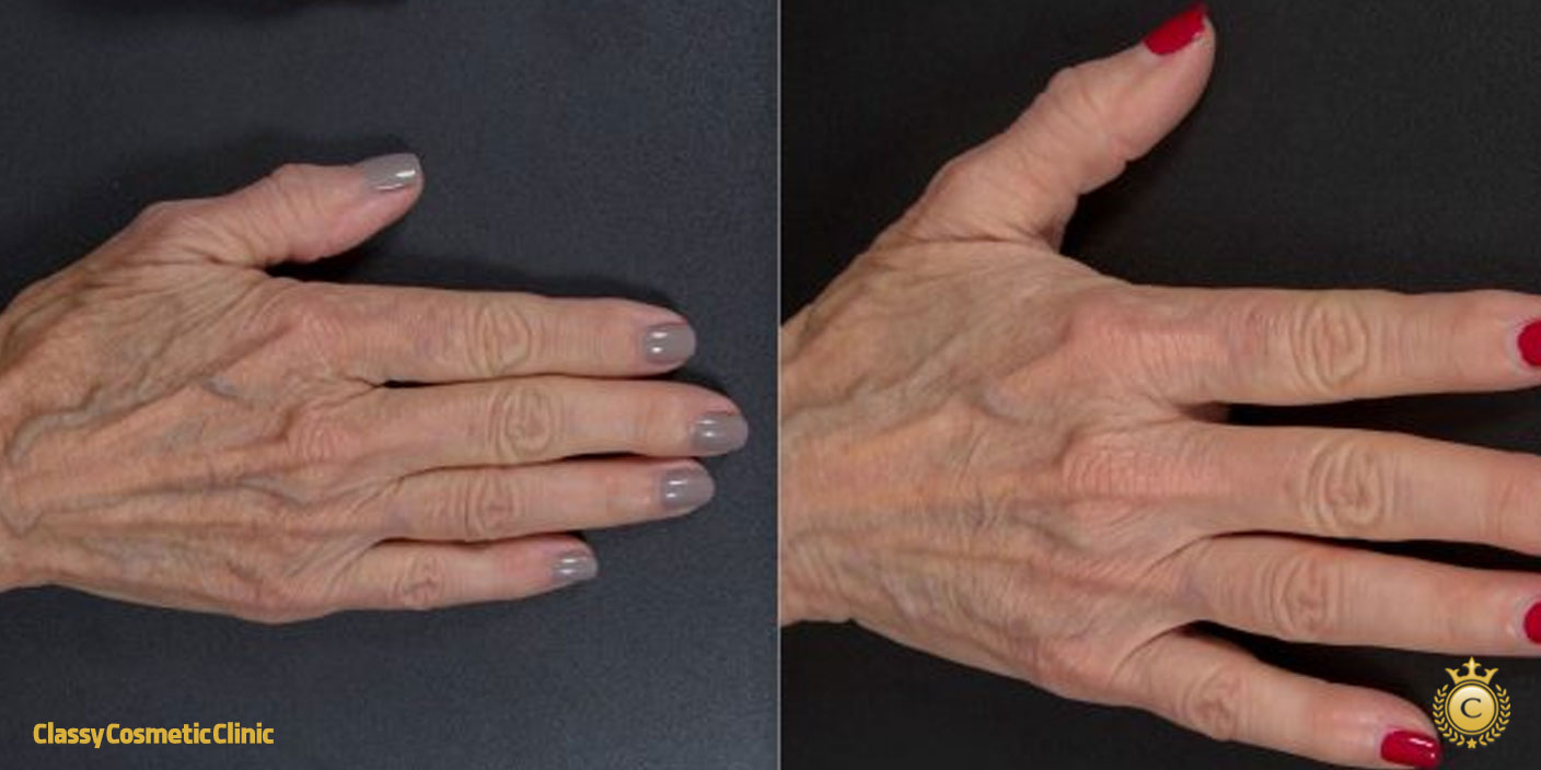 Hand Rejuvenation with Filler Injections before and after