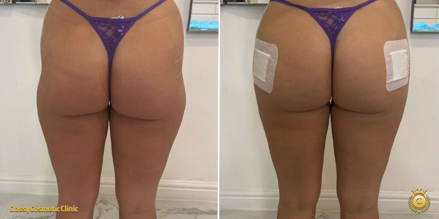 Buttock Filler Injections before and after