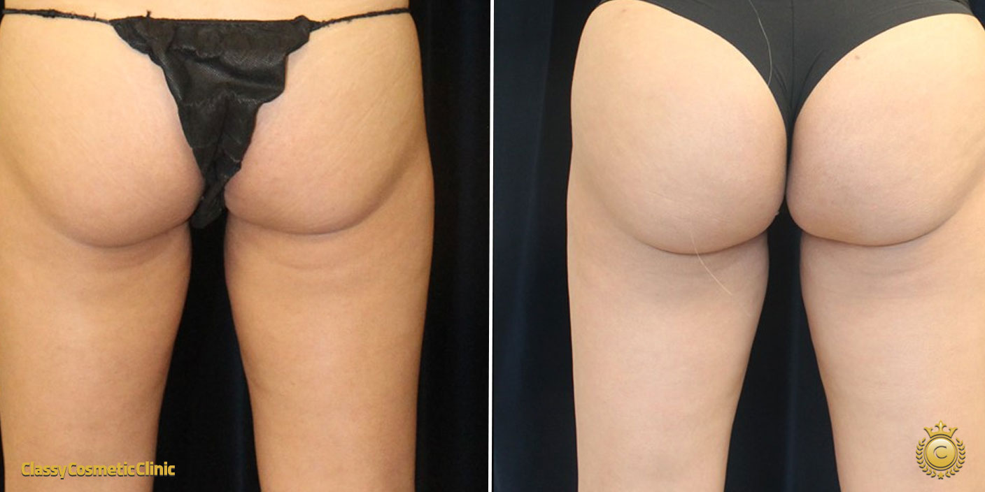 Buttock Filler Injections before and after