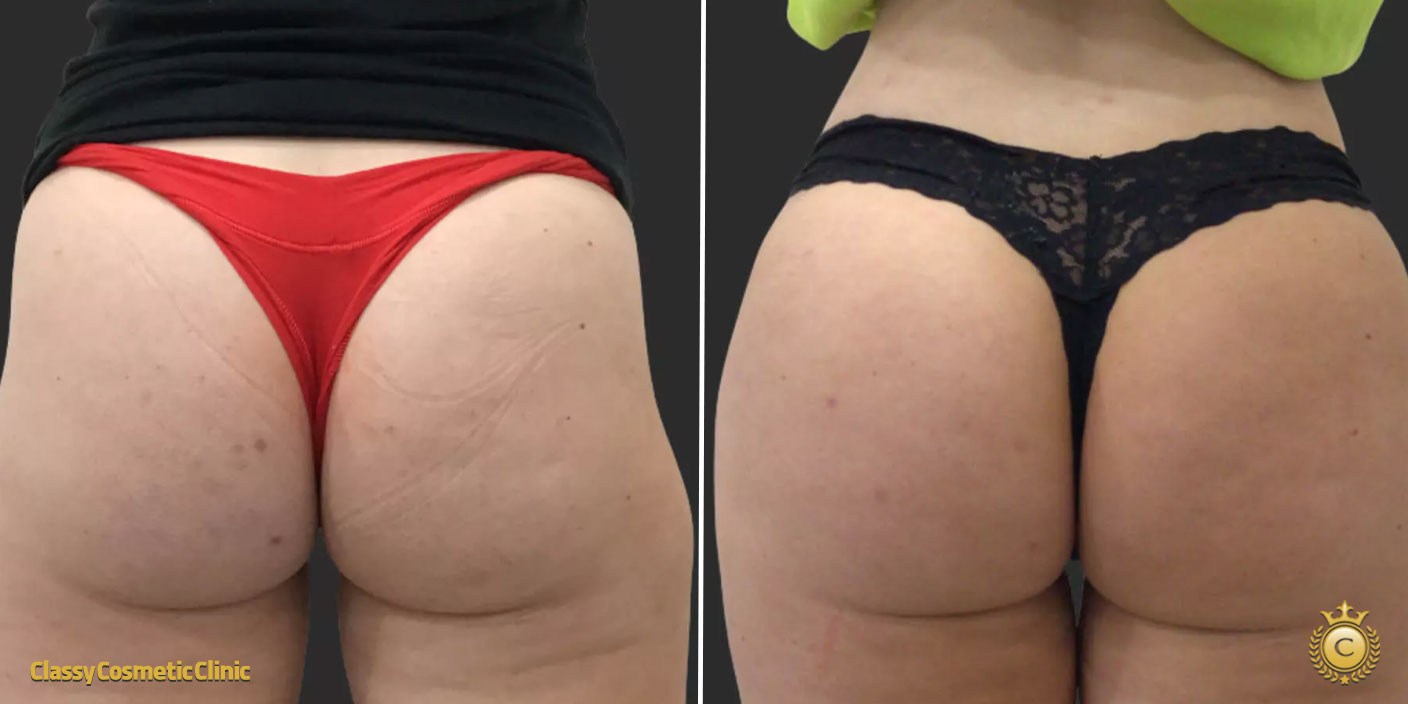 Buttock Filler Injections before and after