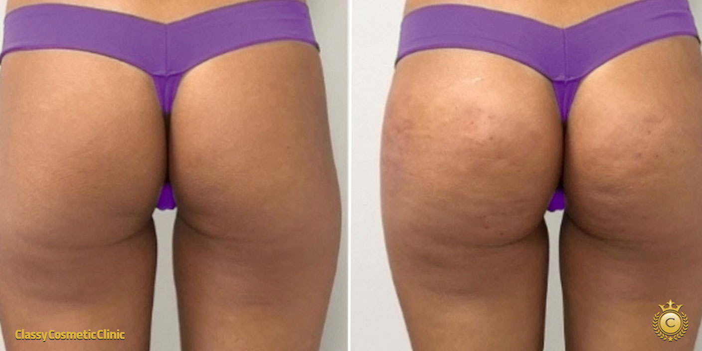 Buttock Filler Injections before and after