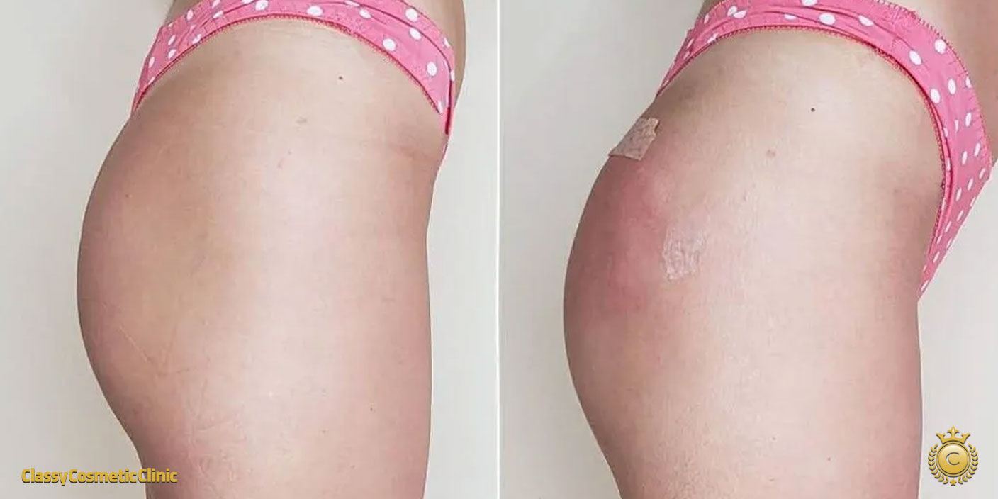 Buttock Filler Injections before and after