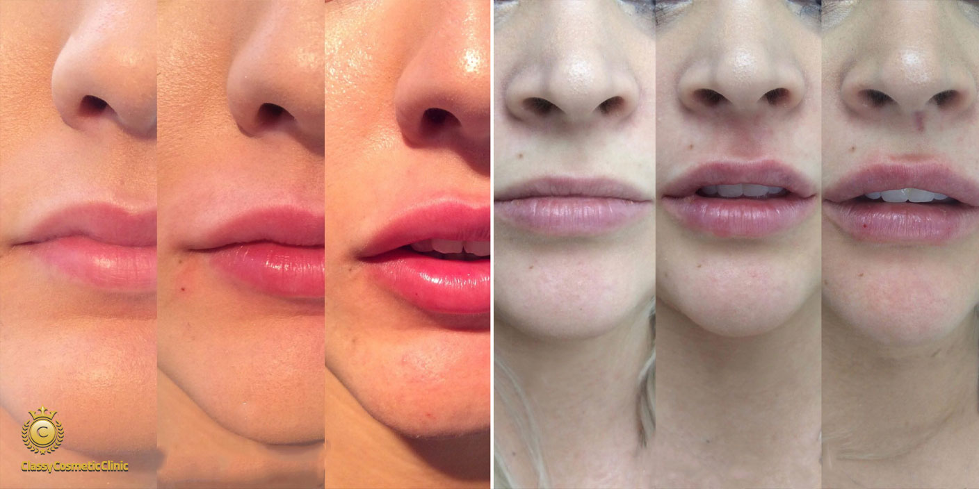 lip filler injection before and after