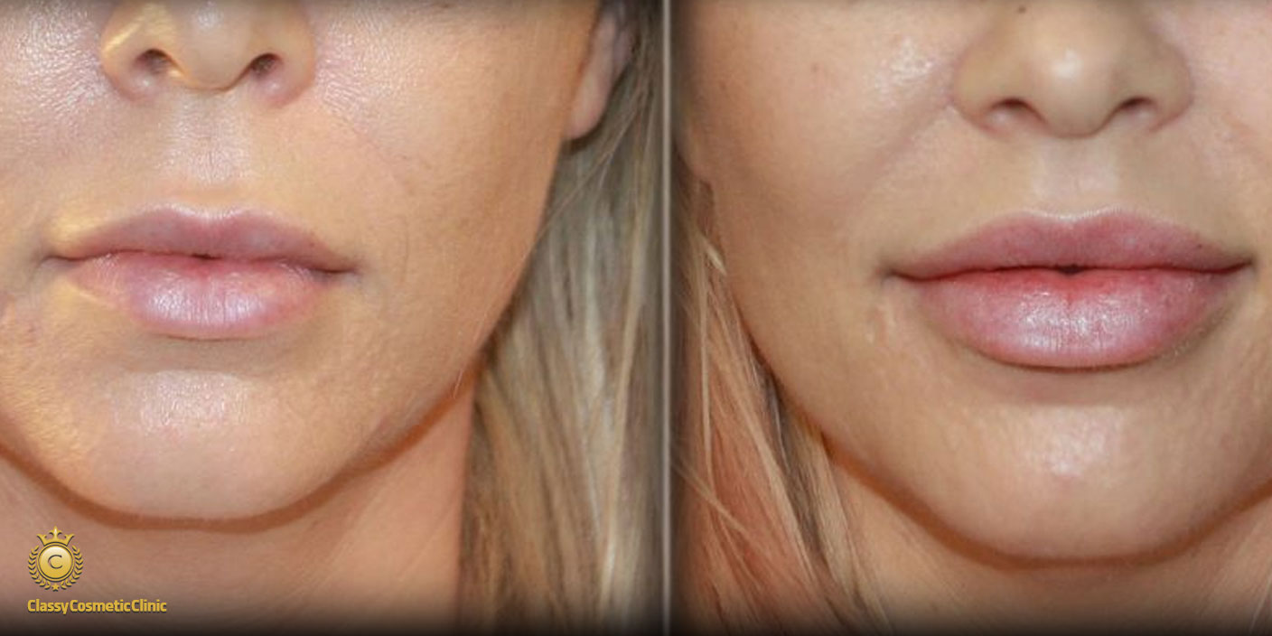 lip filler injection before and after