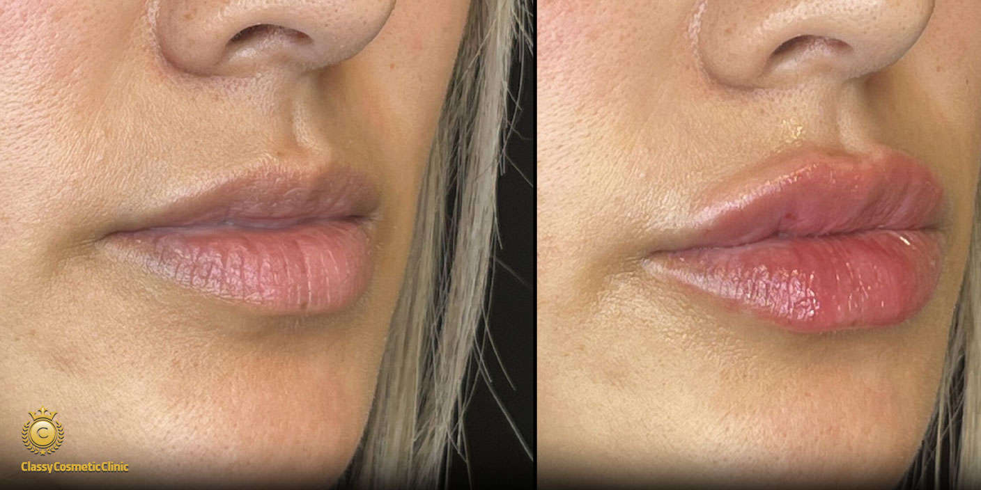 lip filler injection before and after