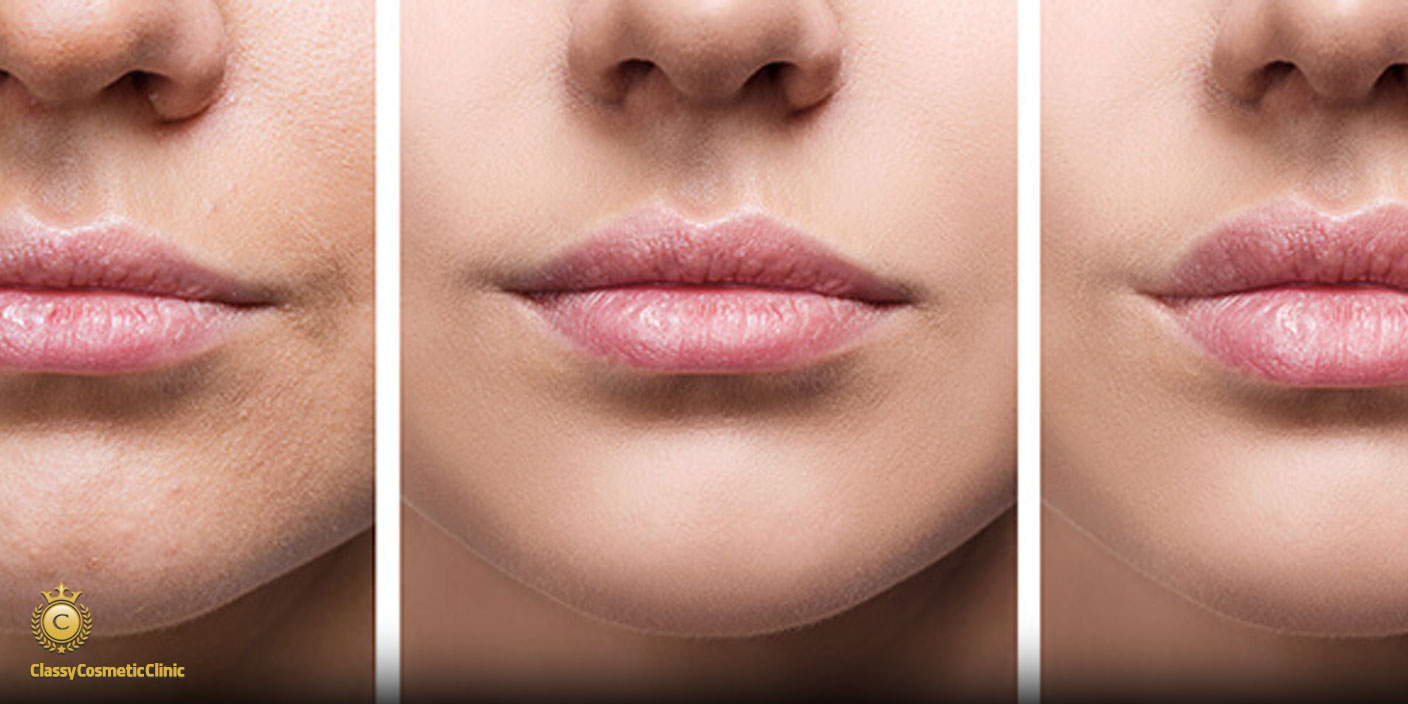 lip filler injection before and after