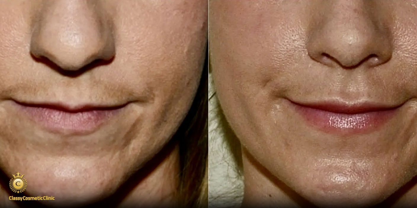 lip filler injection before and after