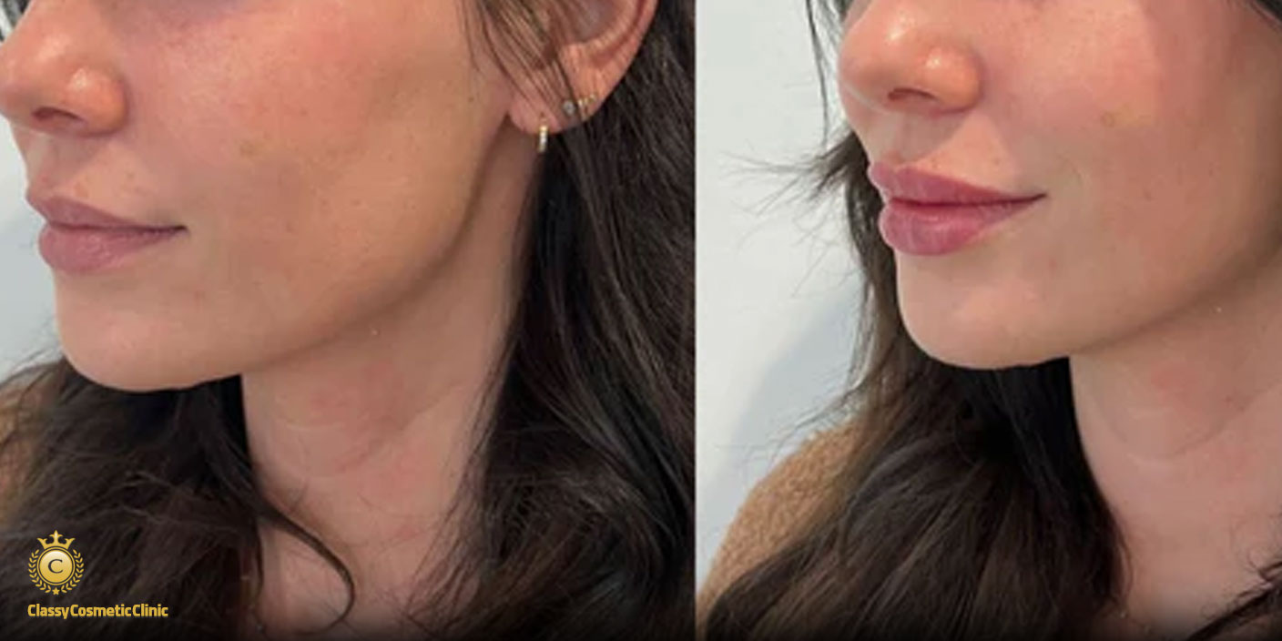 lip filler injection before and after