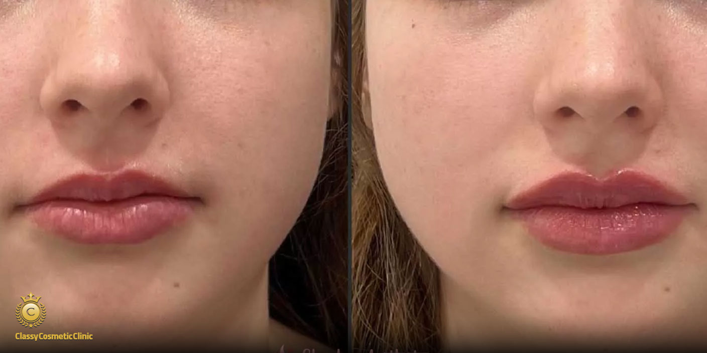 lip filler injection before and after