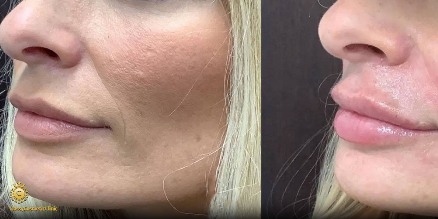 lip filler injection before and after