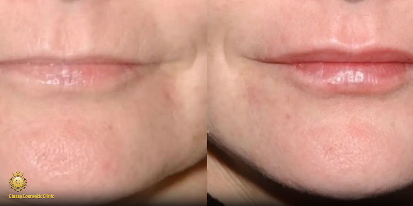 lip filler injection before and after