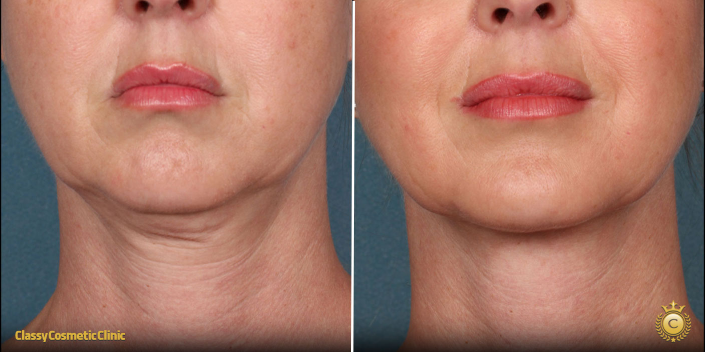 How to Tighten Neck Skin Without Surgery: Effective Non-Surgical Solutions