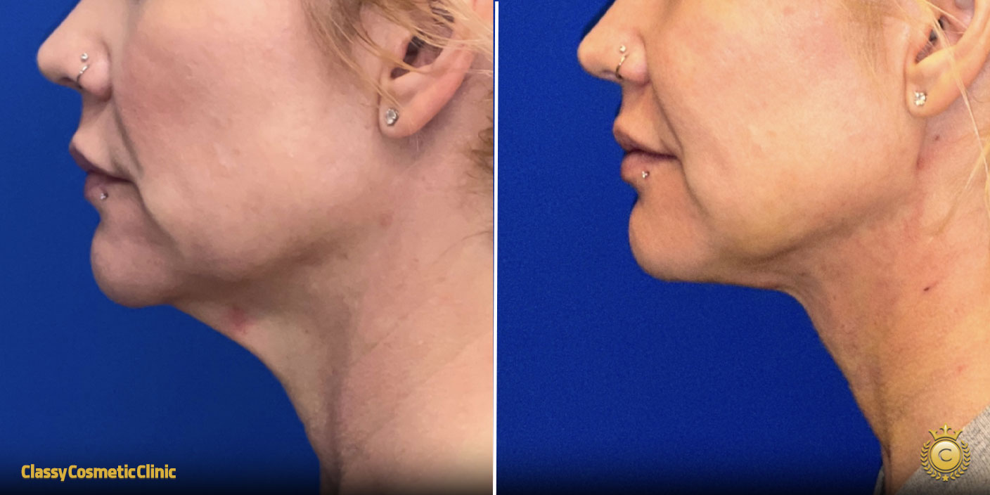 How to Tighten Neck Skin Without Surgery: Effective Non-Surgical Solutions