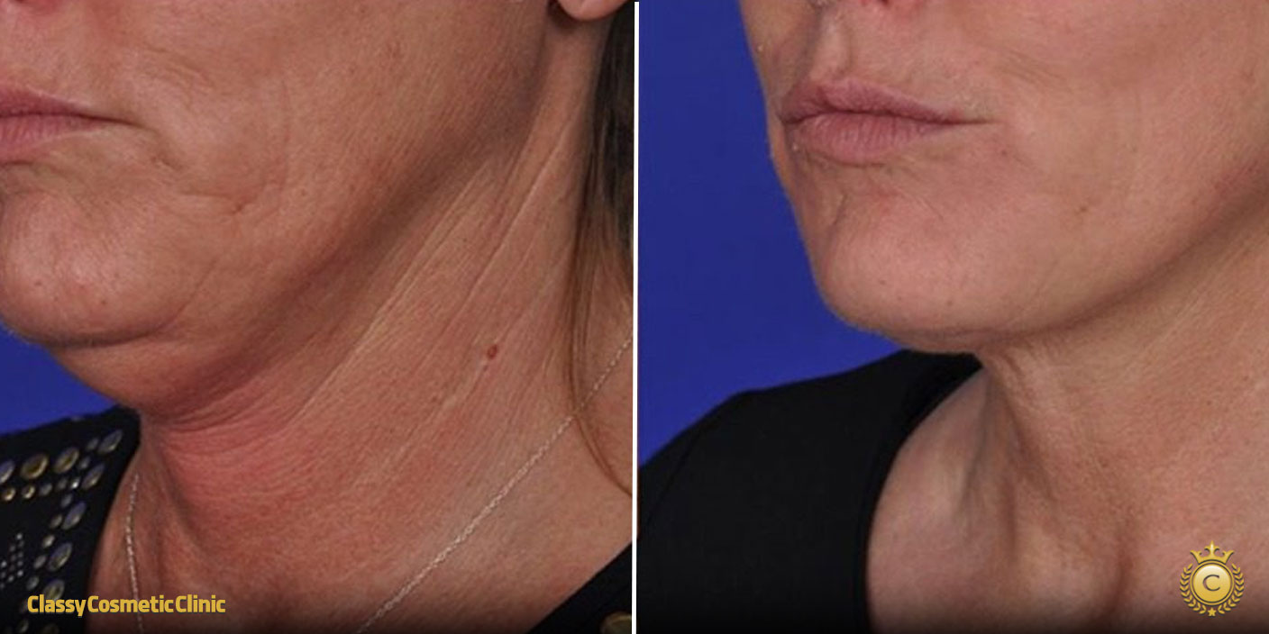 How to Tighten Neck Skin Without Surgery: Effective Non-Surgical Solutions