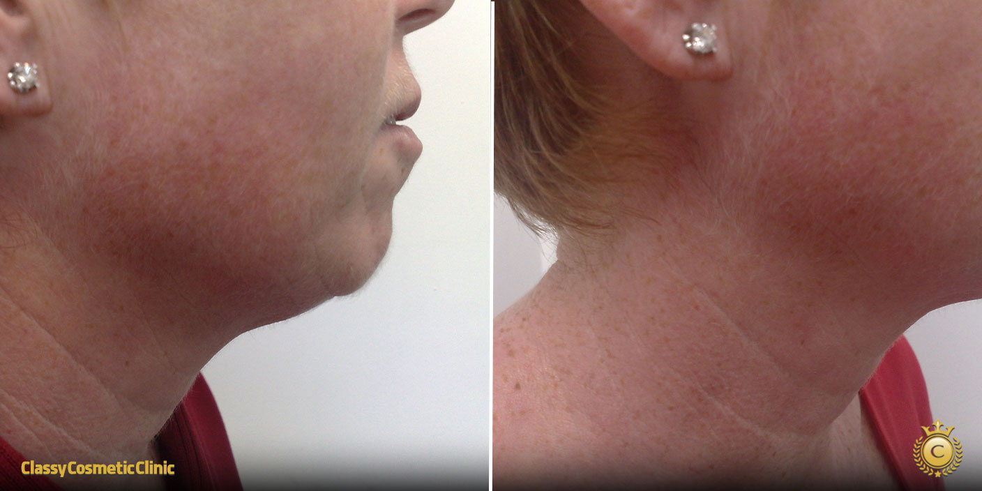 How to Tighten Neck Skin Without Surgery: Effective Non-Surgical Solutions