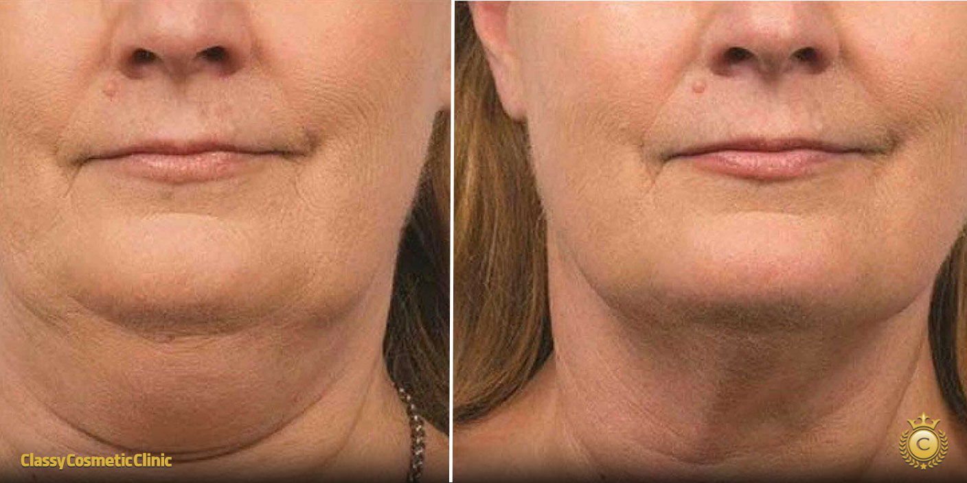 Skin Tightening Under the Chin before and after