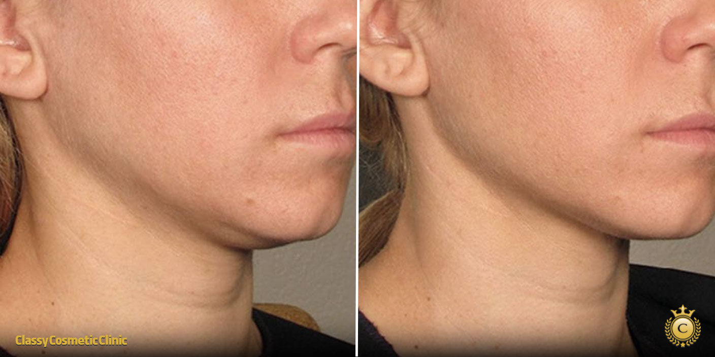 Skin Tightening Under the Chin before and after