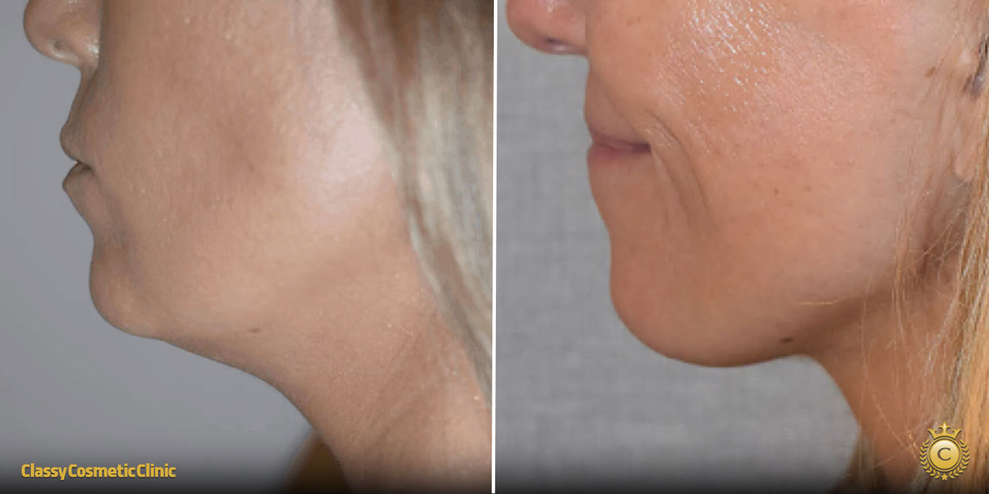 Skin Tightening Under the Chin before and after