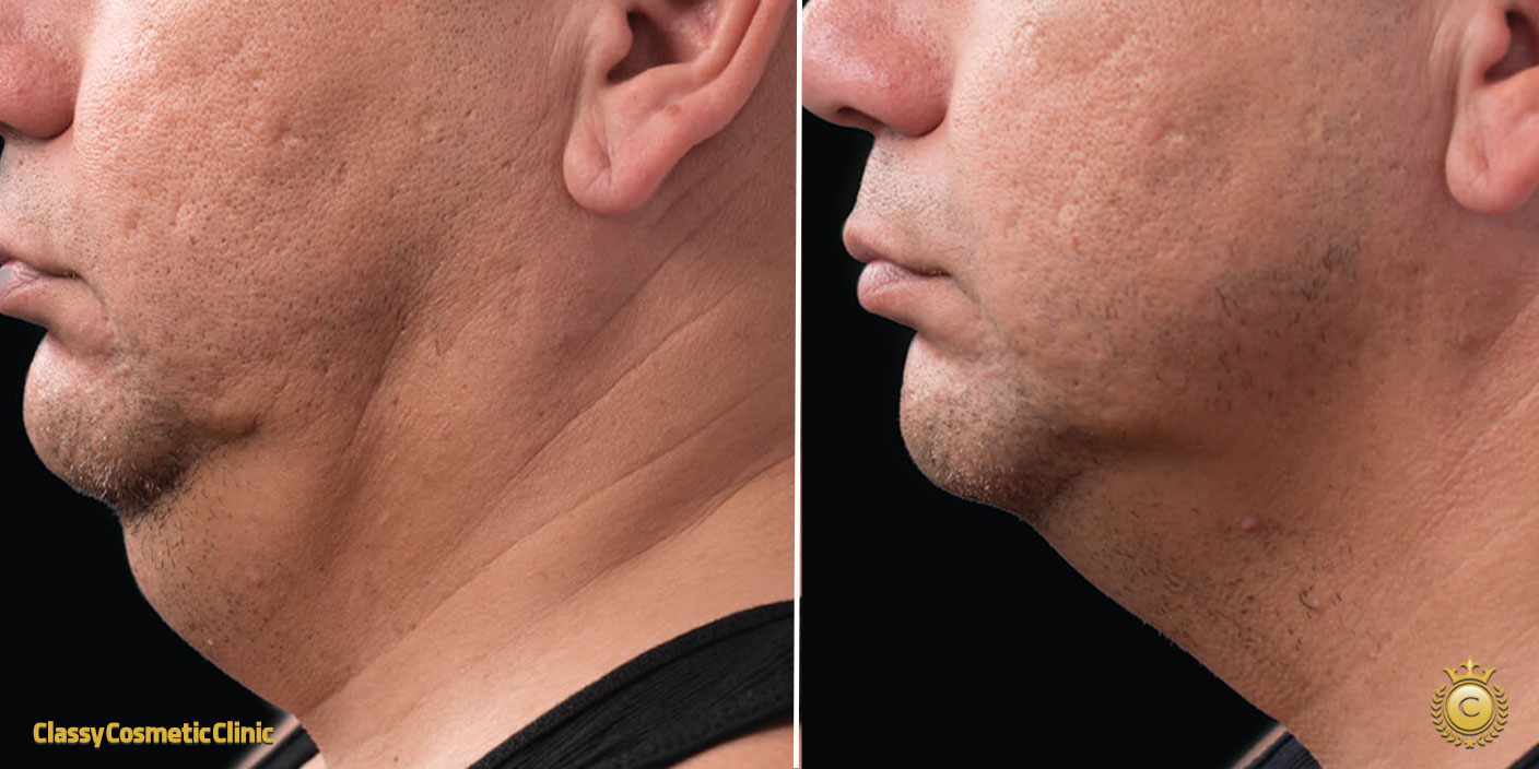 Skin Tightening Under the Chin before and after