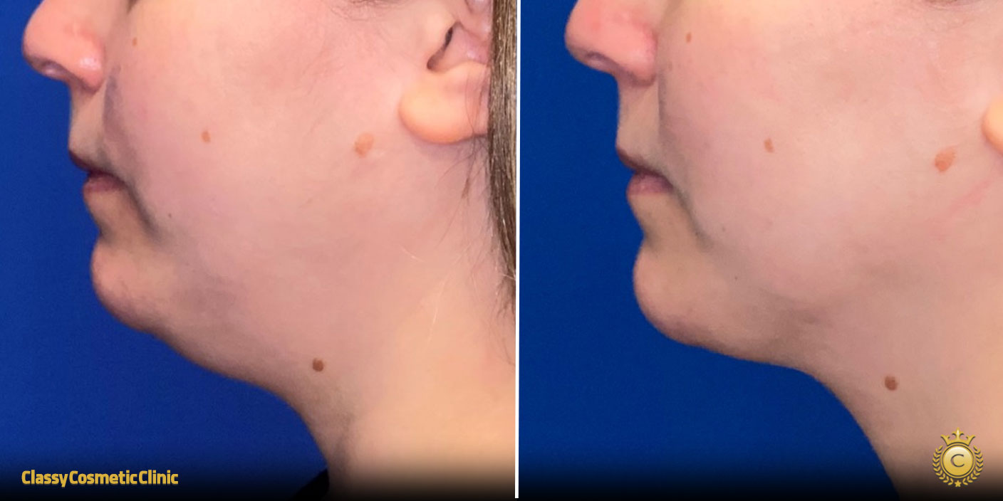 Skin Tightening Under the Chin before and after