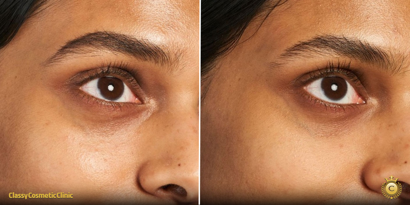 Ultherapy Under Eye