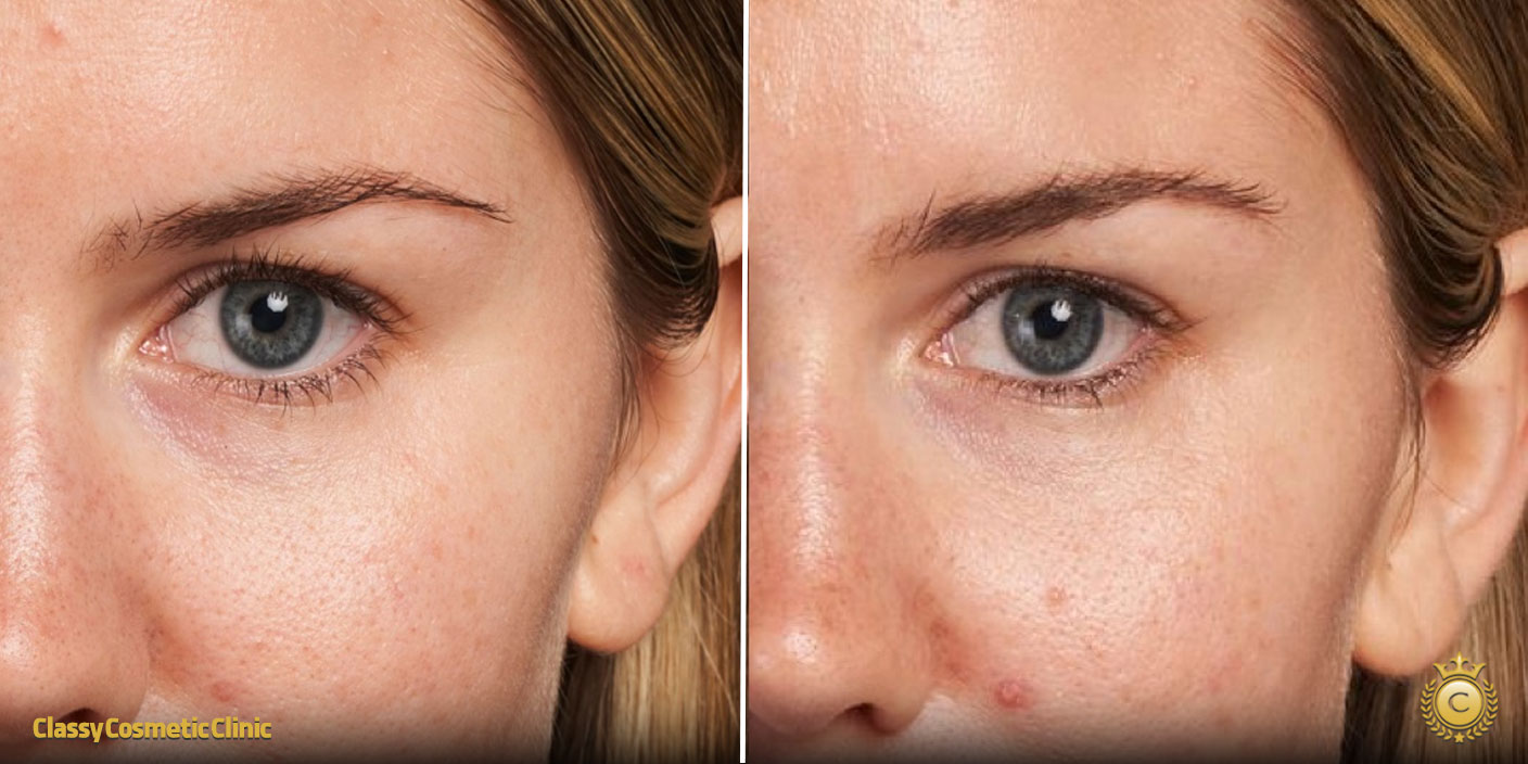 Ultherapy Under Eye