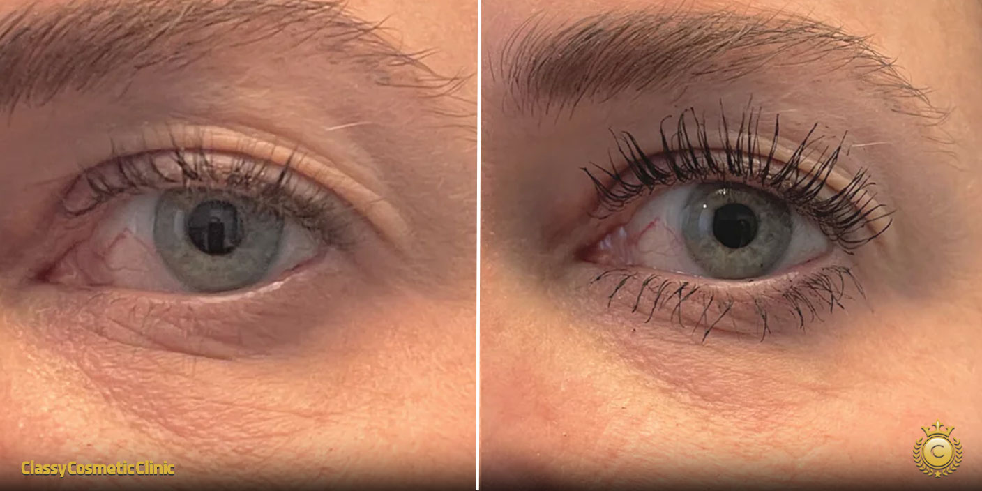 Ultherapy Under Eye