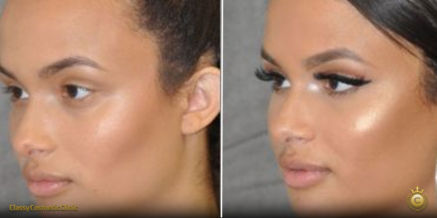 before and after pics of cheek fillers