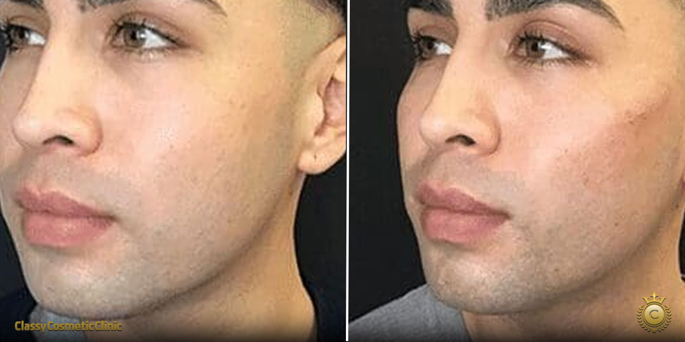 before and after pics of cheek fillers