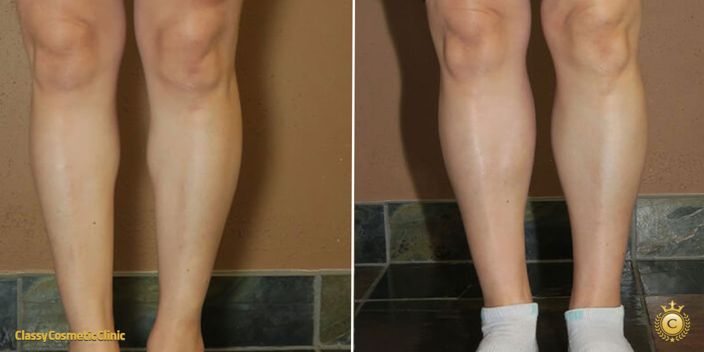 calf filler injection before and after