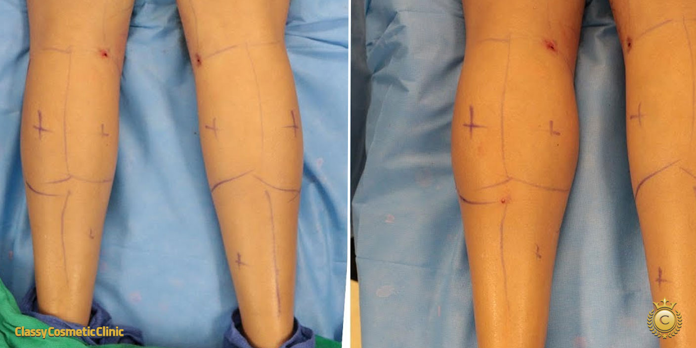 calf filler injection before and after