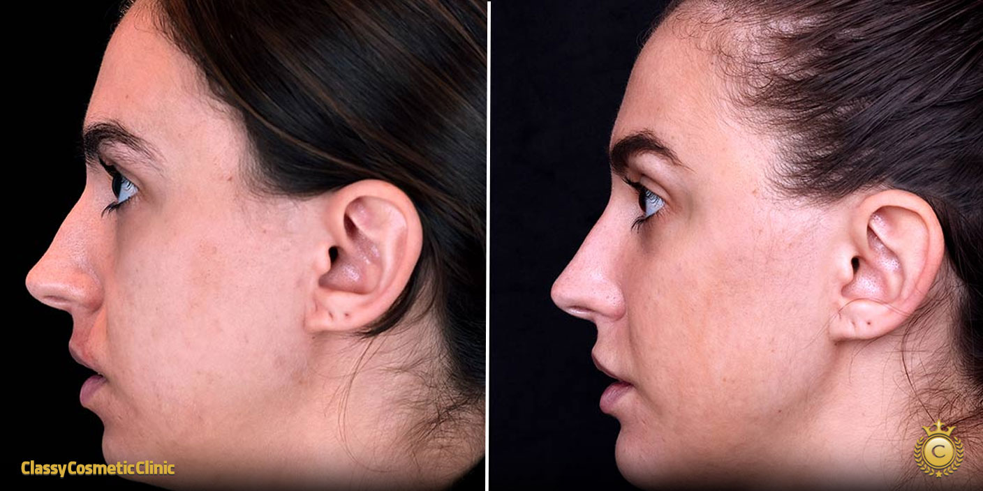 full face filler contouring before and after