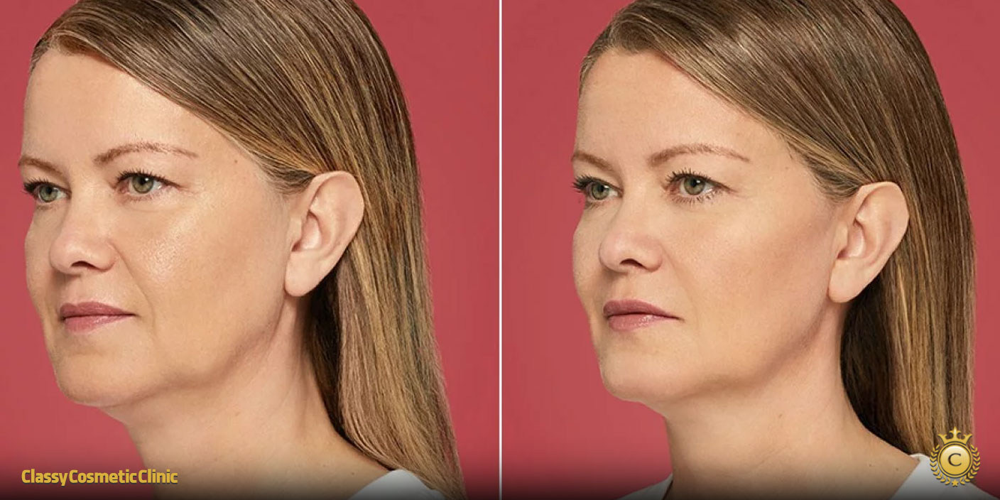 full face filler contouring before and after