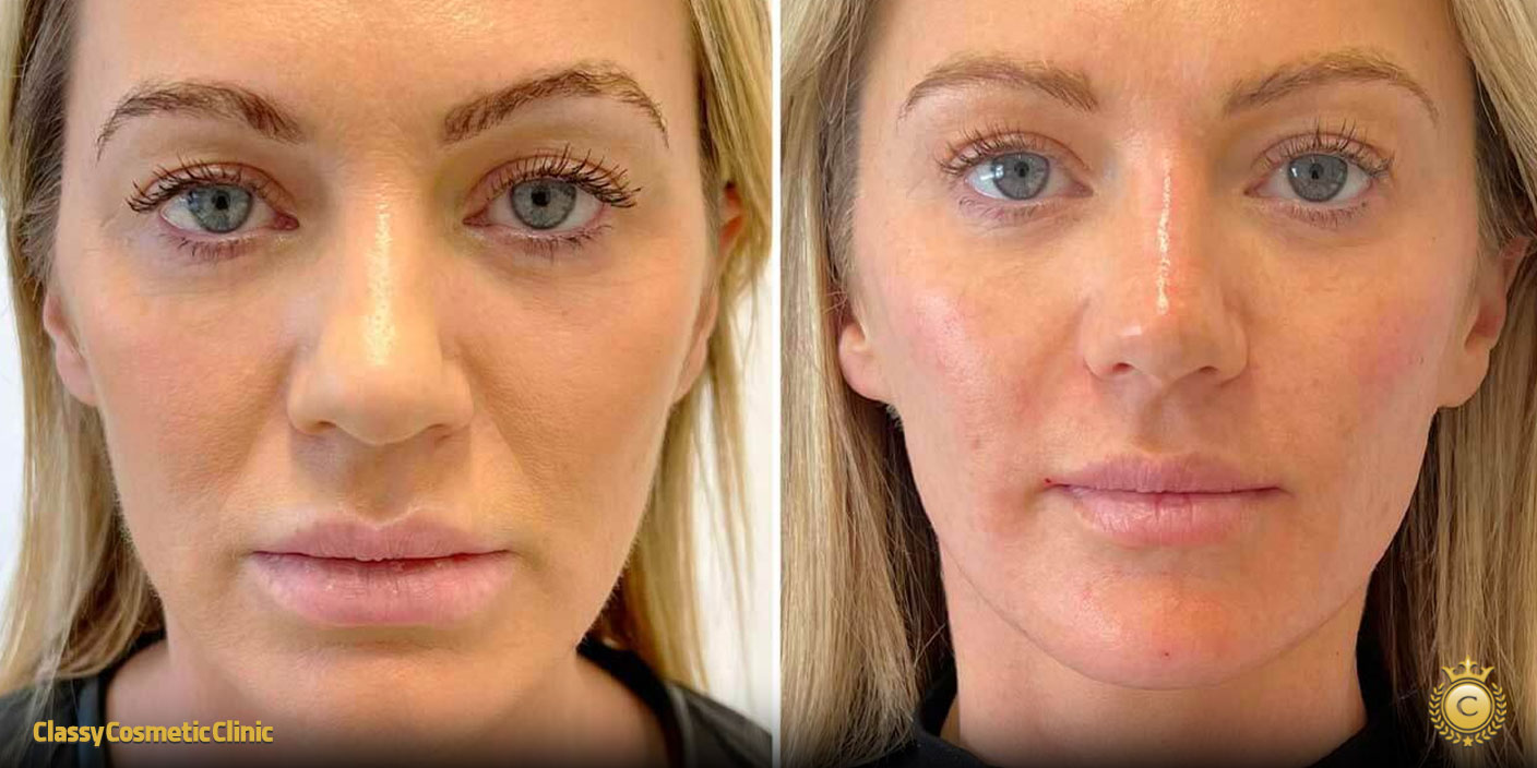 full face filler contouring before and after