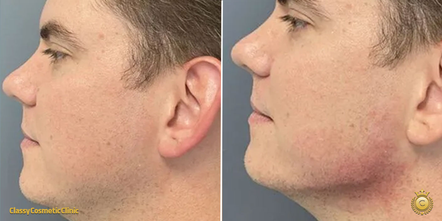 jawline filler injection filler before and after