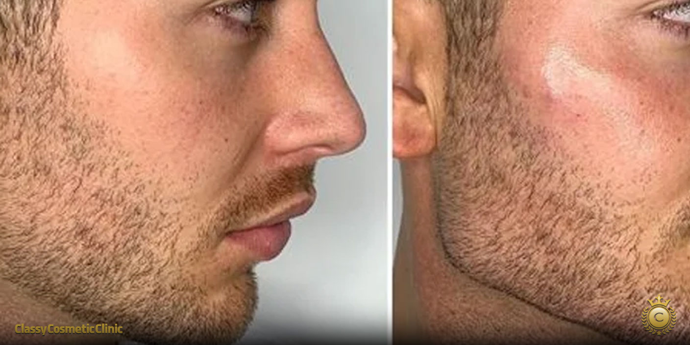 jawline filler injection filler before and after