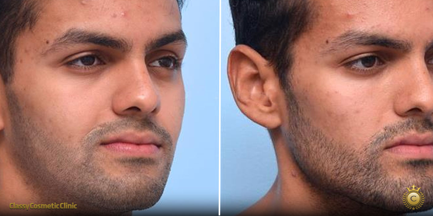 jawline filler injection filler before and after