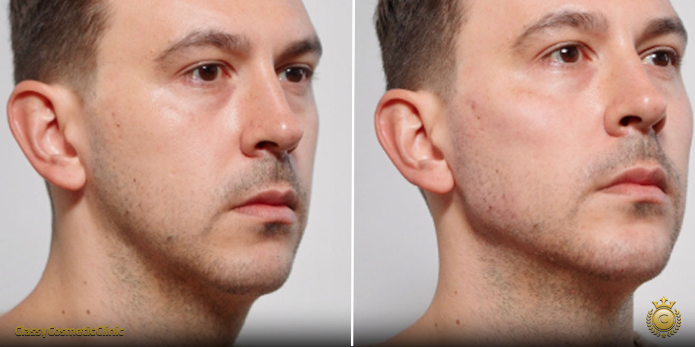 jawline filler injection filler before and after