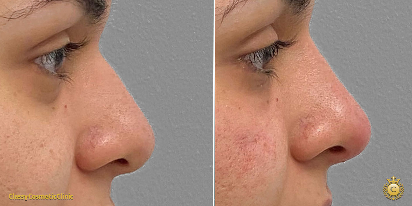 nose filler injection before and after