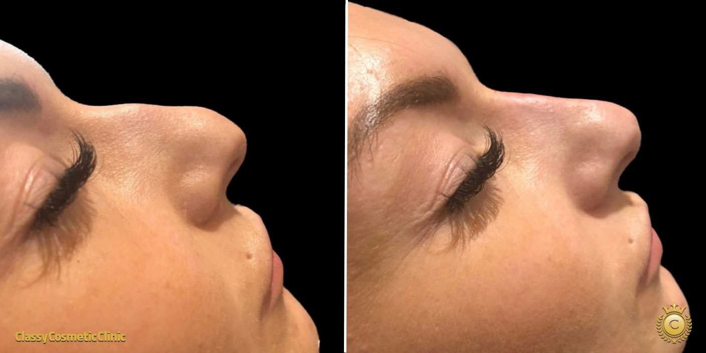 nose filler injection before and after