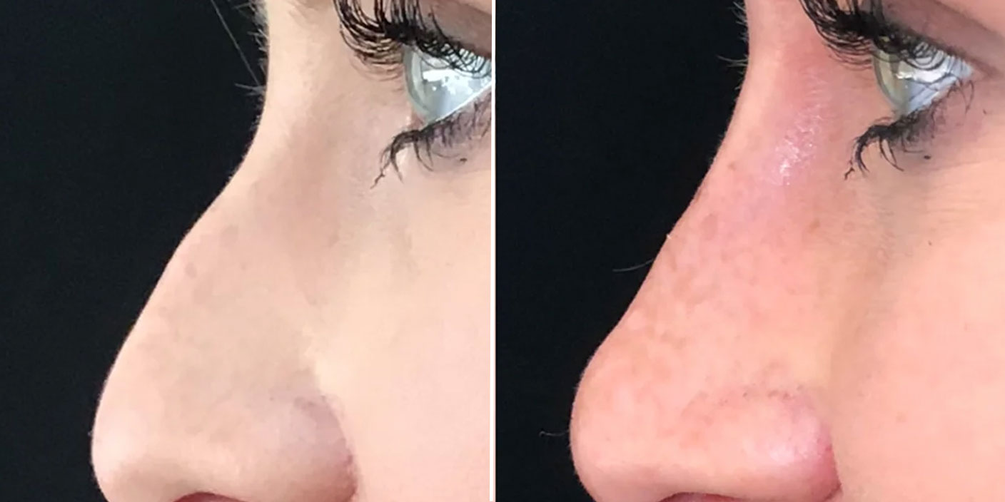 nose filler injection before and after