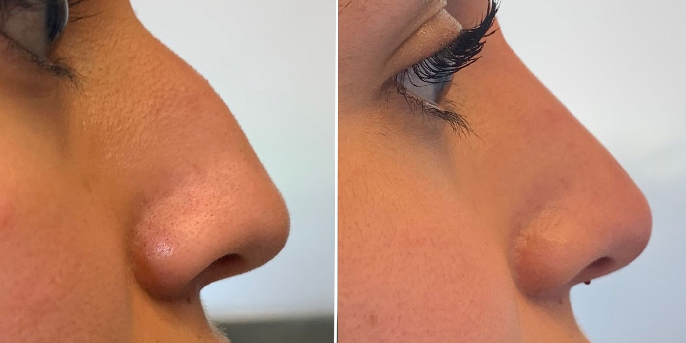 nose filler injection before and after