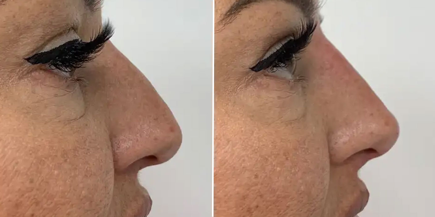 nose filler injection before and after