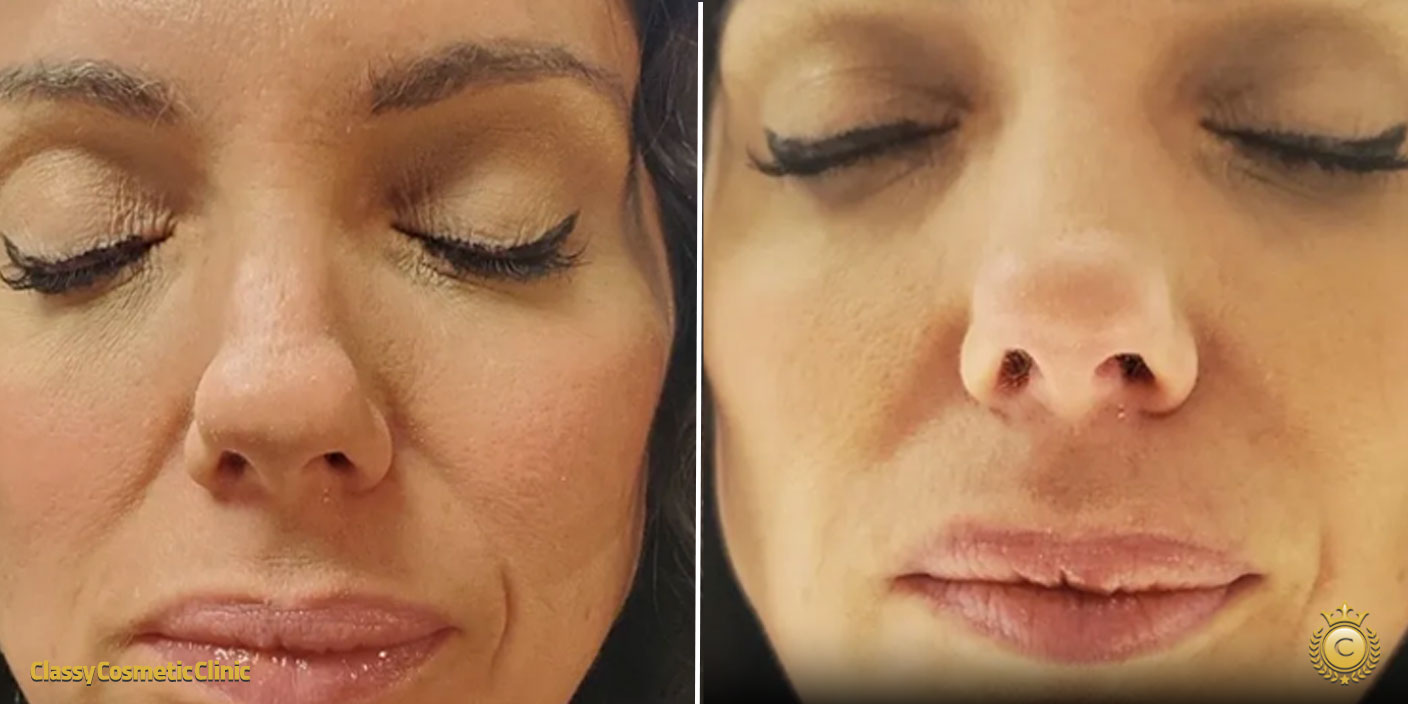 Smile Line Filler before and after